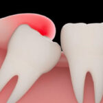 ฟันคุด ปัญหากวนใจของคนที่เริ่มเข้าสู่วัยรุ่น 